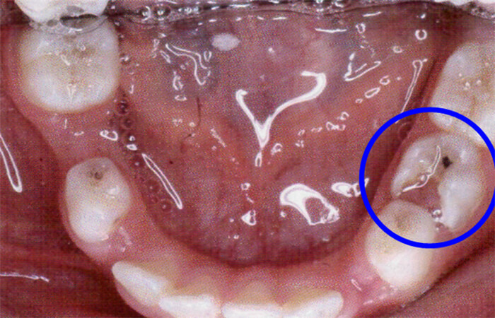 Fig. 9 Presencia de caries que afecta la cara mesial del 75. Paciente Clínica Odontopediatría UGMA