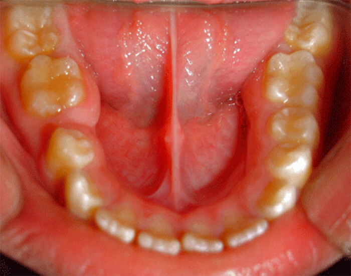 Fig. 11 Disminución del espacio del 45 y de la longitud del arco debido a la Pérdida Prematura del 85. Paciente Clínica Odontopediatria UGMA