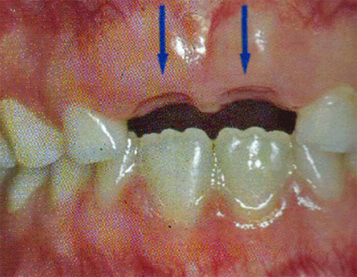 Fig. 12 Queratinización de la mucosa. Tomado de D' Escriván de Saturno. Ortodoncia en Dentición Mixta