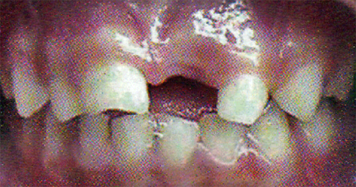 Fig. 13 Pérdida prematura de incisivo central superior izquierdo. Tomado de D' Escriván de Saturno. Ortodoncia en Dentición Mixta¡