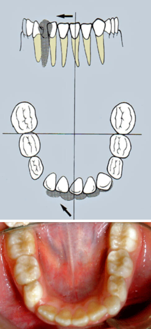 Fig. 14 Representación esquemática de la Pérdida Prematura del 83, con migración de los incisivos permanentes hacia el mismo lado. Tomado de Canut