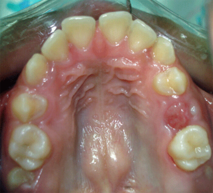 Fig. 15 Pérdida Prematura del 83 Paciente Clínica Odontopediatría UGMA