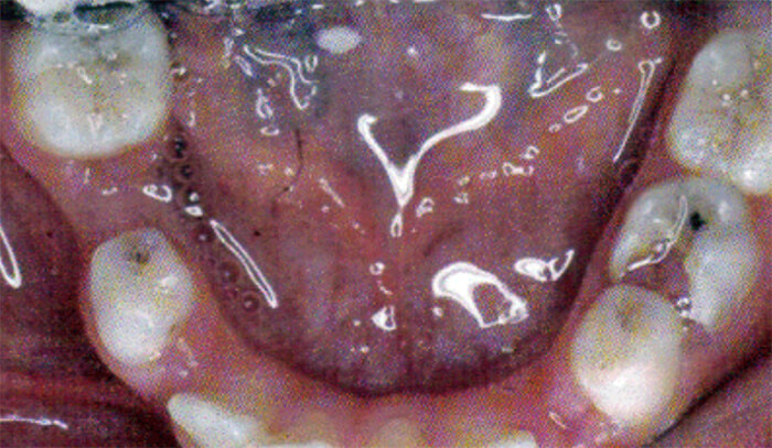 Fig. 16 Pérdida prematura del 85. Tomado de D' Escriván de Saturno. Ortodoncia en Dentición Mixta¡Error! Marcador no definido.