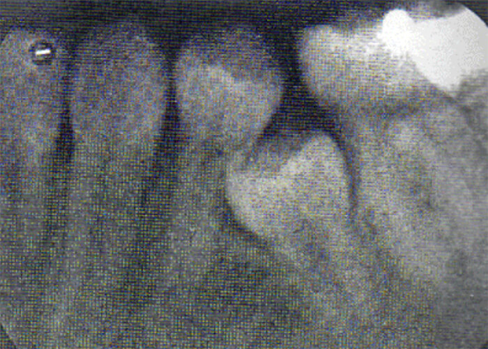 Fig. 17 l molar permanente migro y bloqueo la salida del segundo premolar. Tomado de D' Escriván de Saturno. Ortodoncia en Dentición Mixta.