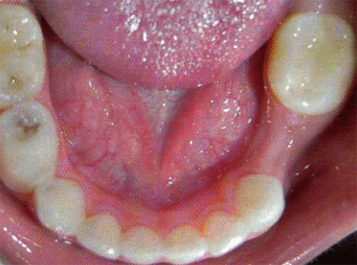 Fig. 18 Pérdida prematura del 85. Tomado de D' Escriván de Saturno. Ortodoncia en Dentición Mixta