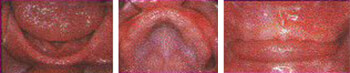 Fig. 19 Paciente con pérdida total de dientes temporales. Tomado de Clemente y col.