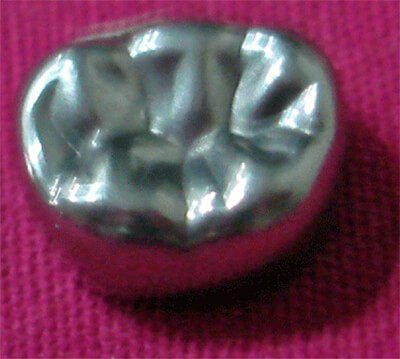 Fig. 20 Corona de acero inoxidable, para dientes temporales, cortesía de Dra. M. Farias de Hong.