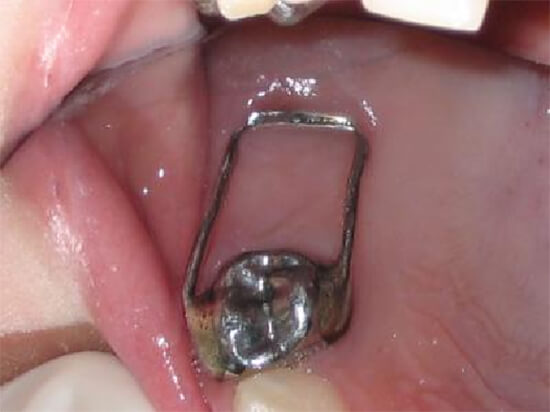 Fig. 25 Mantenedor de espacio en zapata distal en boca del paciente. Tomado de Esaú y col.