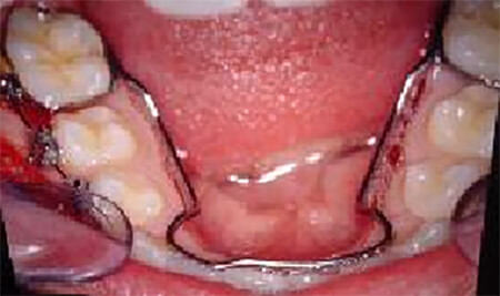 Fig. 26 Mantenedor de espacio en Arco Lingual en boca del paciente. Tomado de Guerrero y col
