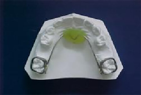 Fig. 27 Mantenedor de espacio en Arco de Nance. En modelo. Tomado de Guerrero y col
