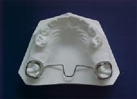 Fig. 28 Mantenedor de espacio en Barra transpalatina. Tomado de Guerrero y col
