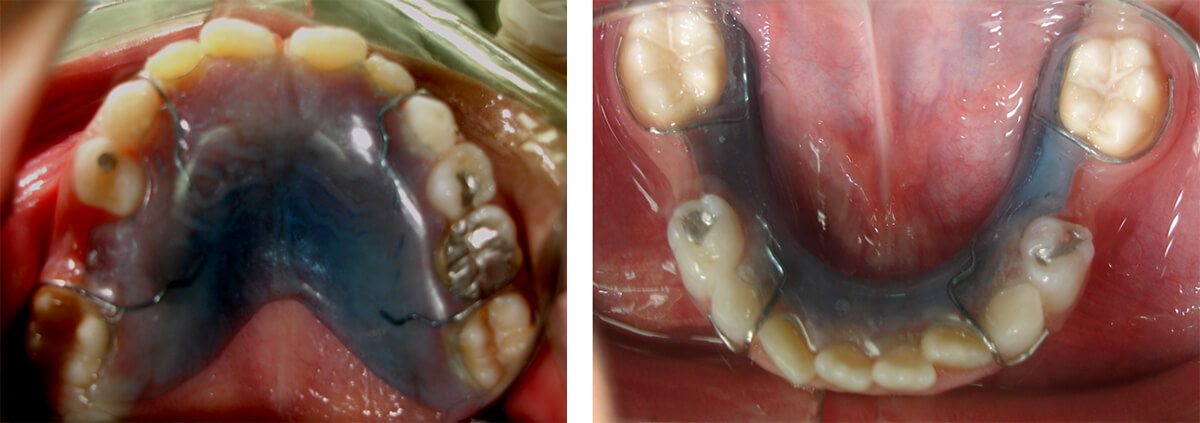 Fig. 29 Mantenedor de espacio removible. Paciente Clínica Odontopediatría UGMA