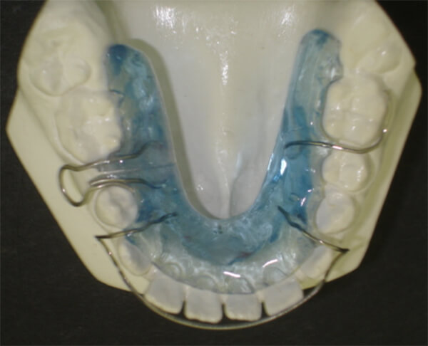Fig. 31 Reganador de espacio en silla de montar. Paciente Clínica Odontopediatría UGMA