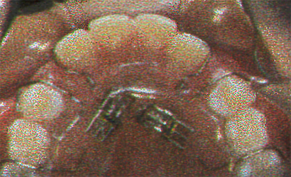 Fig. 32. Reganador de espacio con tornillo. Tomado de Clemente y col.