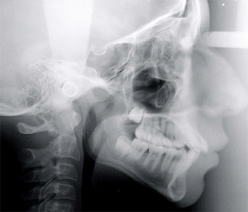 Figura 1 Radiografía cefálica lateral. Fuente: Propia