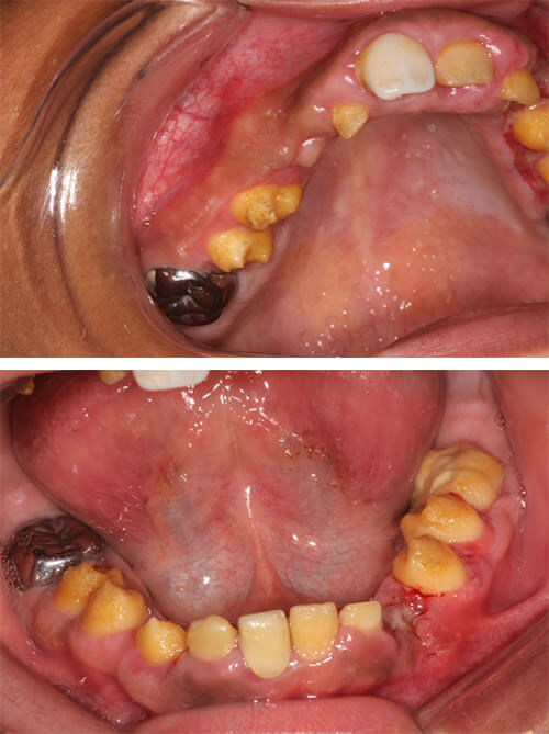 Fig. 2 Imágenes a dos semanas después de la gingivectomía.