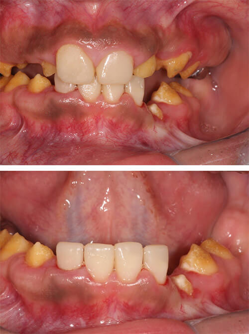 Fig. 3 Fotos finales tomadas una semana después del procedimiento restaurativo de los dientes anteriores.