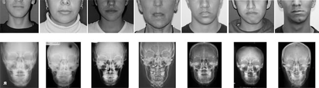 Figura 1 Fotografías y radiografías de los pacientes evaluados, asimetrías leve, moderada y severa