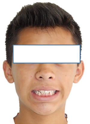 Fig. 3 Sonrisa