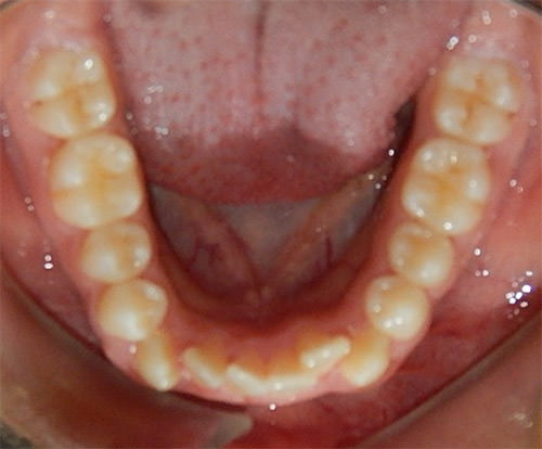 Fig. 7 Oclusal inferior