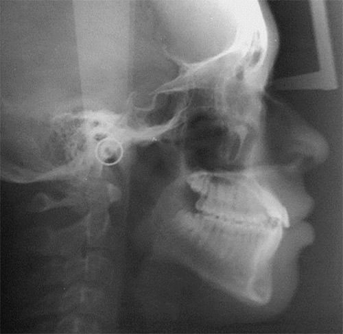 Fig. 8 Radiografía lateral de cráneo