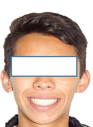Fig. 12 Final de sonrisa