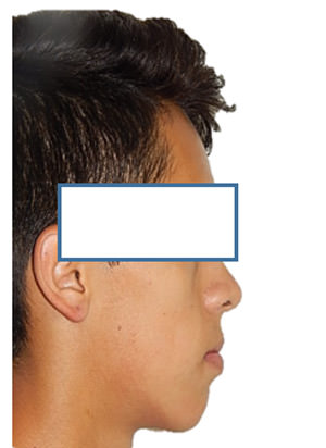Fig. 13 Final de perfil