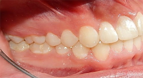 Fig. 15 Lateral derecha