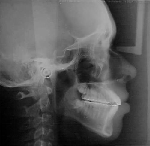 Fig. 17 Radiografía lateral de cráneo