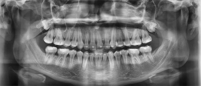 Fig. 18 Radiografía panorámica