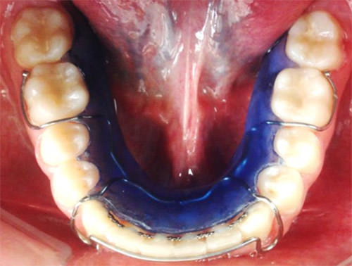 Fig. 20 Retenedor inferior
