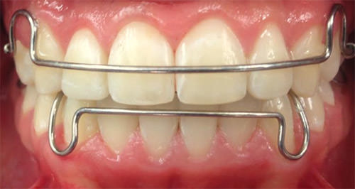 Fig. 21 Retenedores