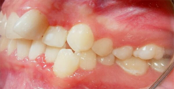 Figura 4 Intraoral lateral izquierda