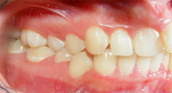 Figura 5 Intraoral lateral derecha