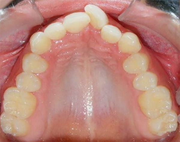 Figura 10 Oclusal superior