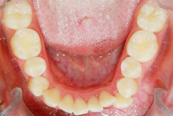 Figura 10 Oclusal superior