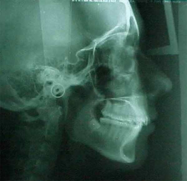 Figura 12 Radiografia lateral de craneo inicial