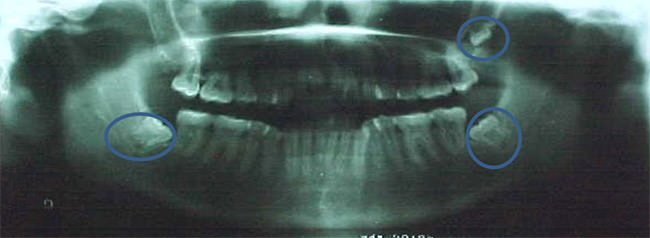 Figura 13 Radiografía panorámica Inicial