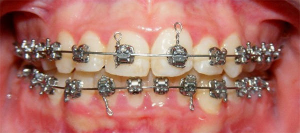 Fig. 14 Intraoral de frente