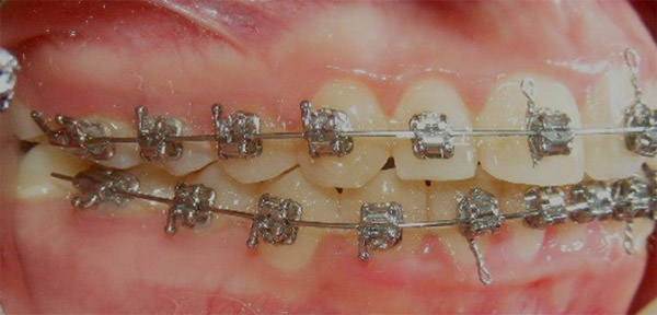 Fig. 15 Intraoral derecha