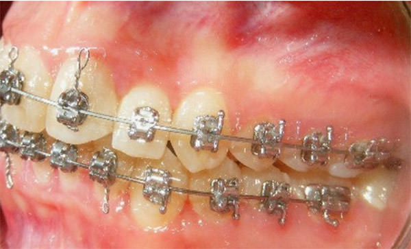 Fig 16 Intraoral izquierda