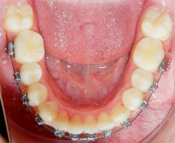 Fig. 17 Oclusal superior