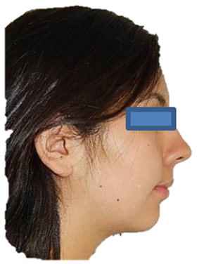 Fig.21 De perfil