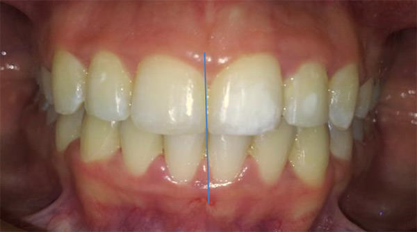 Figura 22 Intraoral de frente