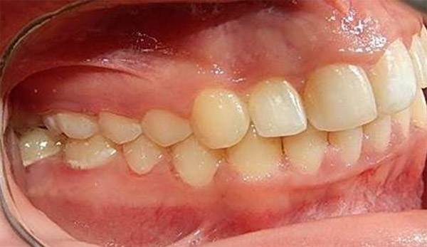 Fig. 23 Lateral derecha