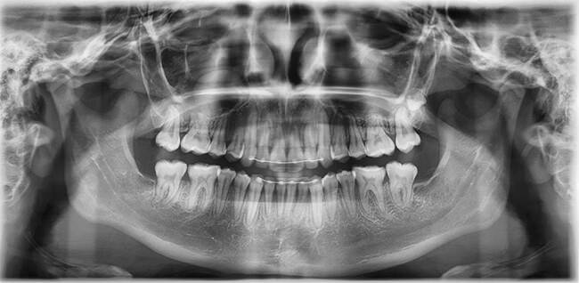 Figura 28 Radiografía panorámica final