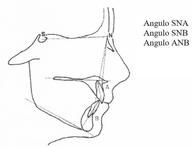 Fig. 1. Puntos y ángulos cefalométricos medidos en el estudio