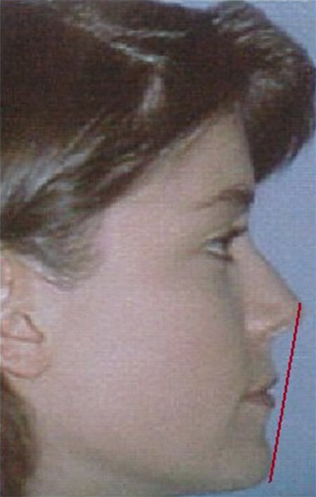 Imagen 1 muestra el trazo de la Línea de Ricketts. Fuente CESO.