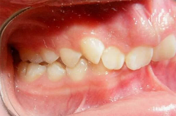 Fig. 4 Lateral Derecha