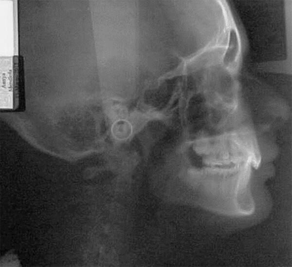 Fig 6 Radiografía lateral.